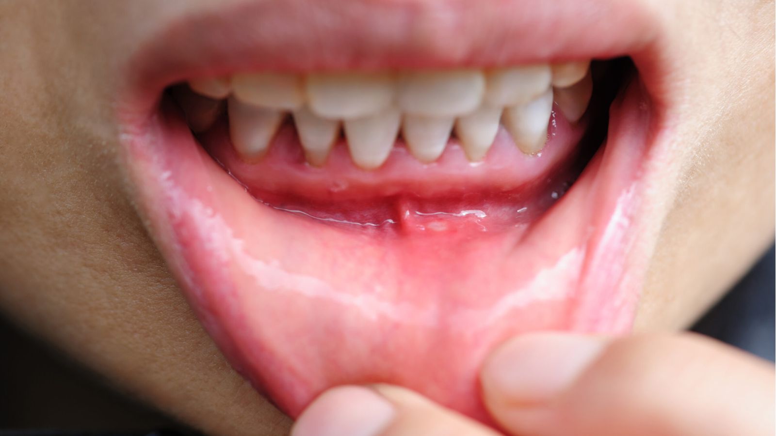 Zahnfleischrückgang