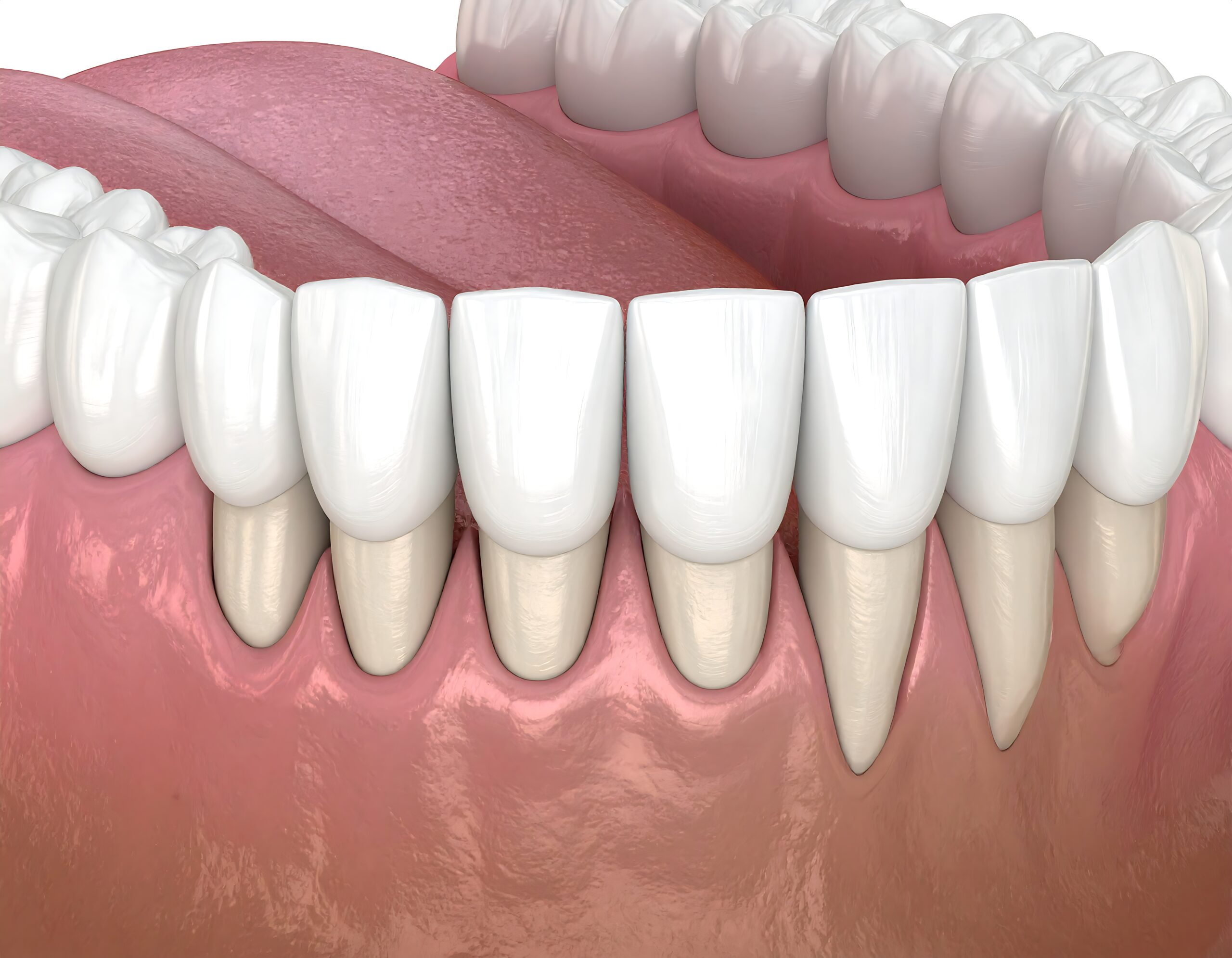 Zahnfleischrückgang, Gingiva