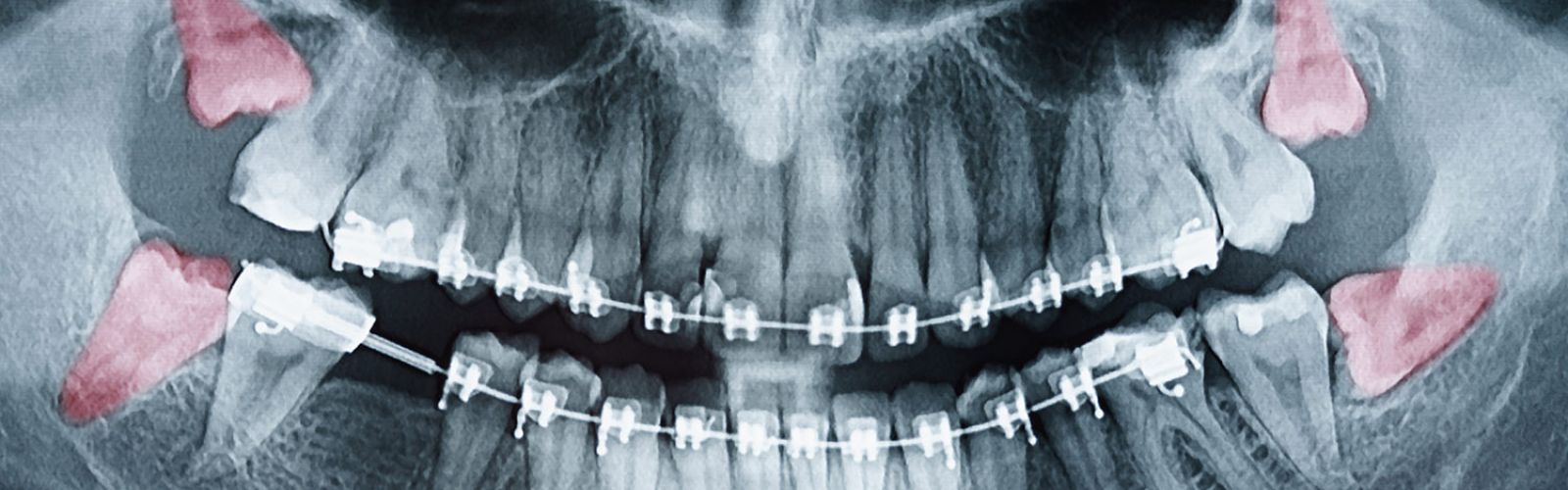 Weisheitszahn Probleme und Schmerzen
