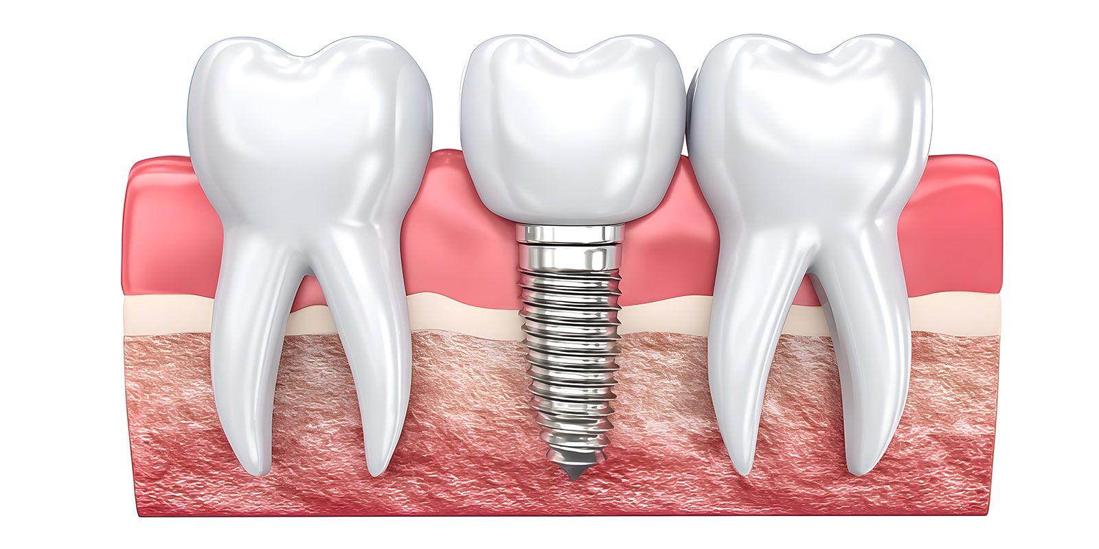 Zahnimplantat schmerzt